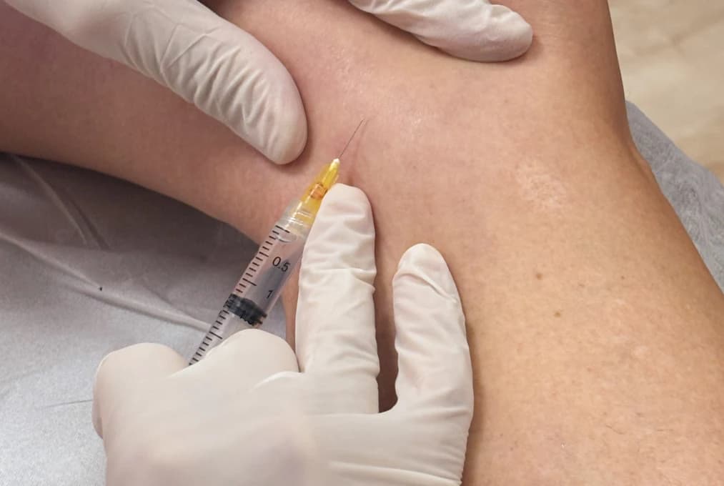 Escleroterapia Líquida