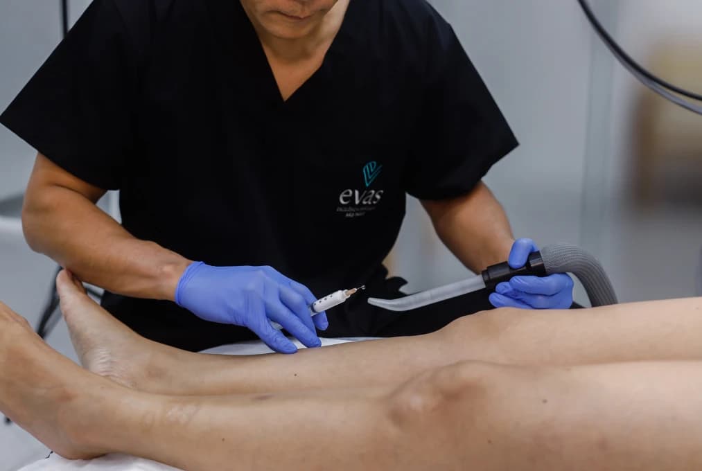 Escleroterapia Líquida