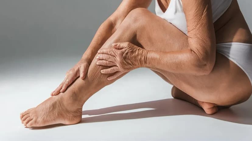 Menopausa e varizes: por que os vasinhos aparecem mais nessa fase?