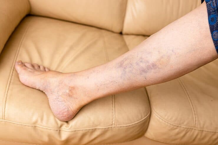 Tromboflebite superficial: o que é, sintomas, quando é grave e como tratar