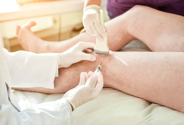 Escleroterapia com espuma: o que é e quando é indicada