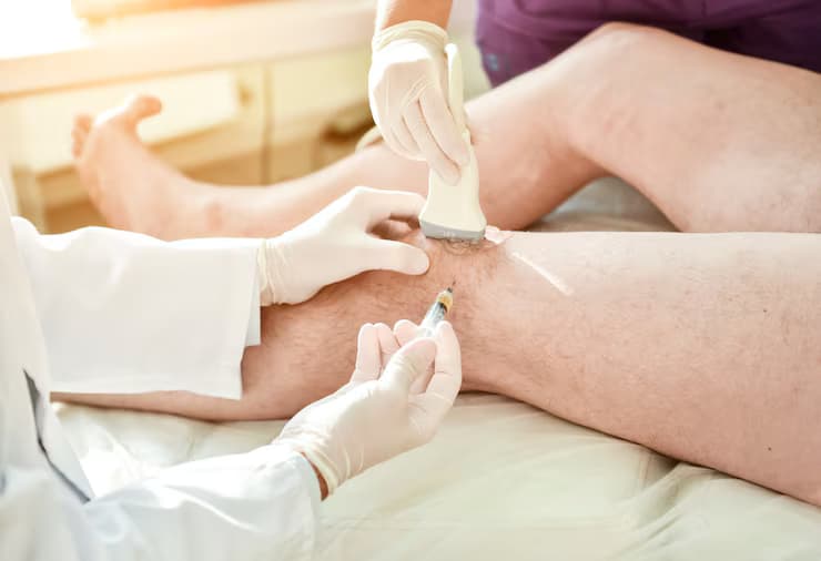 Escleroterapia com espuma: o que é e quando é indicada