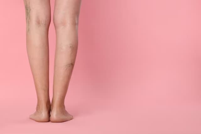 Radiofrequência para Vasinhos: Como Funciona e Comparação com o Laser
