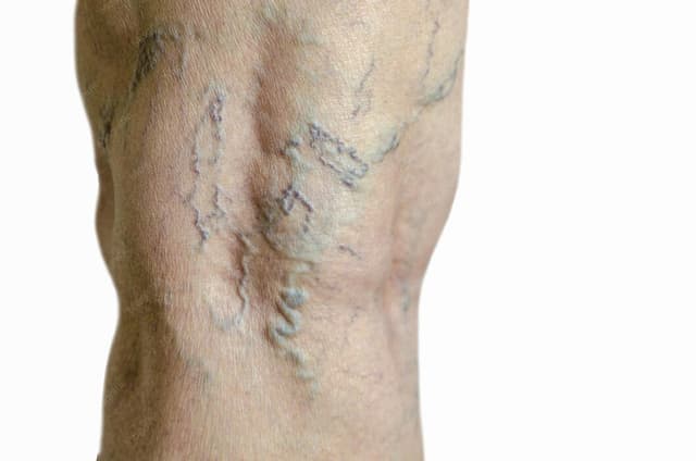 Varizes em homens: por que acontecem e por que muitos não tratam