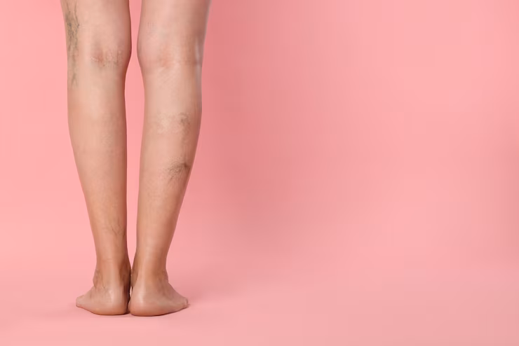 Radiofrequência para Vasinhos: Como Funciona e Comparação com o Laser